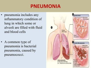 PNEUMONIA
• pneumonia includes any
inflammatory condition of
lung in which some or
alveoli are filled with fluid
and blood cells
• A common type of
pneumonia is bacterial
pneumonia, caused by
pneumococci.
 