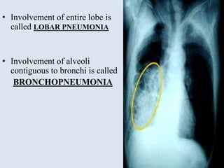 • Involvement of entire lobe is
called LOBAR PNEUMONIA
• Involvement of alveoli
contiguous to bronchi is called
BRONCHOPNEUMONIA
 