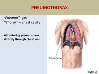 PNEUMOTHORAX
– “Pneumo”- gas
“Thorax” – chest cavity
– Air entering pleural space
directly through chest wall
 