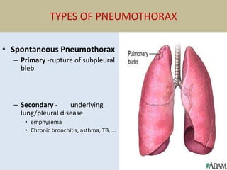 TYPES OF PNEUMOTHORAX
• Spontaneous Pneumothorax
– Primary -rupture of subpleural
bleb
– Secondary - underlying
lung/pleural disease
• emphysema
• Chronic bronchitis, asthma, TB, …
 