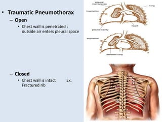• Traumatic Pneumothorax
– Open
• Chest wall is penetrated :
outside air enters pleural space
– Closed
• Chest wall is intact Ex.
Fractured rib
 