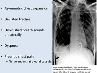 • Asymmetric chest expansion
• Deviated trachea
• Diminished breath sounds
unilaterally
• Dyspnea
• Pleuritic chest pain
– Nerve endings at pleural capsule
 