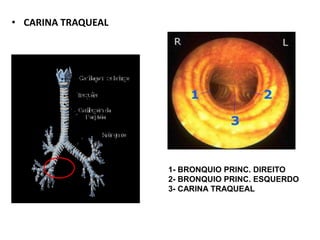 • CARINA TRAQUEAL
1- BRONQUIO PRINC. DIREITO
2- BRONQUIO PRINC. ESQUERDO
3- CARINA TRAQUEAL
 