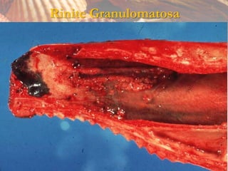 Rinite Granulomatosa
 