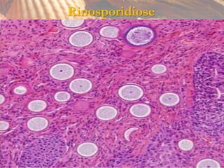 Rinosporidiose
 