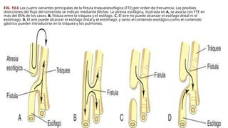 FIG. 10.6 Las cuatro variantes principales de la fístula traqueoesofágica (FTE) por orden de frecuencia. Las posibles
direcciones del flujo del contenido se indican mediante flechas. La atresia esofágica, ilustrada en A, se asocia con FTE en
más del 85% de los casos. B, Fístula entre la tráquea y el esófago. C, El aire no puede alcanzar el esófago distal ni el
estómago. D, El aire puede alcanzar el esófago distal y el estómago, y tanto el contenido esofágico como el contenido
gástrico pueden introducirse en la tráquea y los pulmones.
 