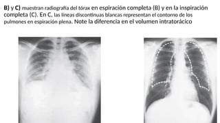 B) y C) muestran radiografía del tórax en espiración completa (B) y en la inspiración
completa (C). En C, las líneas discontinuas blancas representan el contorno de los
pulmones en espiración plena. Note la diferencia en el volumen intratorácico
 