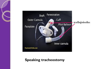 ทางเปิ ดสู่ กล่ องเสี ยง

Speaking tracheostomy

 