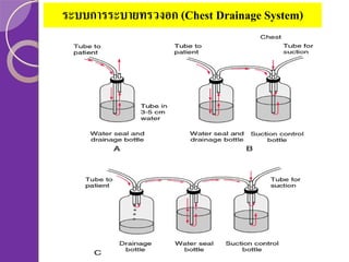 ระบบการระบายทรวงอก (Chest Drainage System)

 