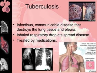 Tuberculosis
• Infectious, communicable disease that
destroys the lung tissue and pleura.
• Inhaled respiratory droplets spread disease.
• Treated by medications.
 