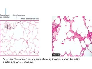 Panacinar (Panlobular) emphysema showing involvement of the entire
lobules and whole of acinus.
 