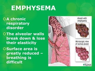 Emphy Respiratory-and-Circulatory-Diseases.ppt