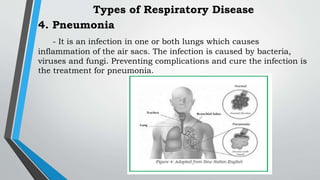 4. Pneumonia
- It is an infection in one or both lungs which causes
inflammation of the air sacs. The infection is caused by bacteria,
viruses and fungi. Preventing complications and cure the infection is
the treatment for pneumonia.
Types of Respiratory Disease
 