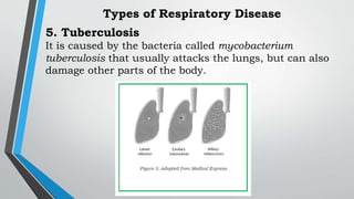 5. Tuberculosis
It is caused by the bacteria called mycobacterium
tuberculosis that usually attacks the lungs, but can also
damage other parts of the body.
Types of Respiratory Disease
 