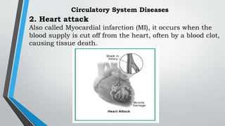 2. Heart attack
Also called Myocardial infarction (MI), it occurs when the
blood supply is cut off from the heart, often by a blood clot,
causing tissue death.
Circulatory System Diseases
 