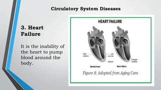 3. Heart
Failure
It is the inability of
the heart to pump
blood around the
body.
Circulatory System Diseases
 