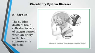 5. Stroke
The sudden
death of brain
cells due to lack
of oxygen caused
when an artery
in the brain
ruptures or is
blocked.
Circulatory System Diseases
 