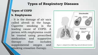 Types of COPD
b. Emphysema
- It is the damage of air sacs
called alveoli in the lungs.
Cigarette smoking is the
leading cause of COPD. A
person with emphysema could
be treated using prescribed
medication and supportive
therapy that includes
supplemental oxygen and
smoking cessation therapy.
Types of Respiratory Diseases
 