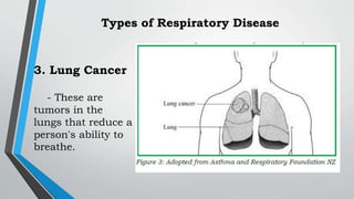 3. Lung Cancer
- These are
tumors in the
lungs that reduce a
person's ability to
breathe.
Types of Respiratory Disease
 