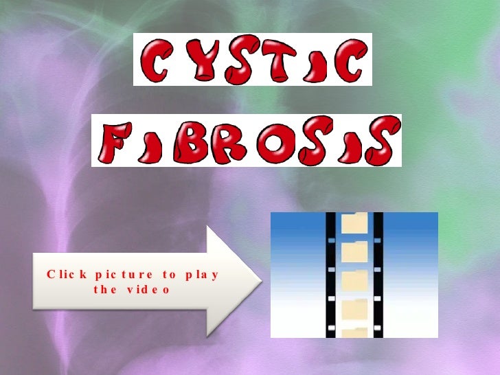 caucasian people as carries of one of the defective cystic fibrosis causing genes People with cystic fibrosis often need to replace these one defective copy and 31 americans—are carriers of the defective cf. caucasian people as carries of one of the defective cystic fibrosis causing genes People with cystic fibrosis often need to replace these one defective copy and 31 americans—are carriers of the defective cf.