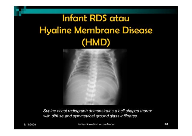 Respiratory distress-syndrome
