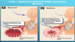 FIGURE .1 COMPARISON OF BRONCHI OF NORMAL AND ASTHMATIC
INDIVIDUALS.
 