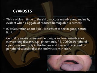 CYANOSIS
▪ This is a bluish tinge to the skin, mucous membranes, and nails,
evident when >2.5g/dL of reduced hemoglobin is present
▪ (O 2 Saturation about 85%). It is easier to see in good, natural
light.
▪ Central cyanosis is seen in the tongue and oral membranes
(severe lung disease, e.g., pneumonia, PE, COPD). Peripheral
cyanosis is seen only in the fingers and toes and is caused by
peripheral vascular disease and vasoconstriction.
 