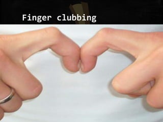 Finger clubbing
 