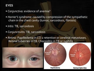 EYES
• Conjunctiva: evidence of anemia?
• Horner’s syndrome: caused by compression of the sympathetic
chain in the chest cavity (tumor, sarcoidosis, fibrosis)
• Iritis: TB, sarcoidosis
• Conjunctivitis: TB, sarcoidosis
• Retina: Papilledema in CO 2 retention or cerebral metastases.
Retinal tubercles inTB. Choroiditis inTB or syphilis
 