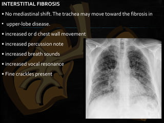 INTERSTITIAL FIBROSIS
• No mediastinal shift.The trachea may move toward the fibrosis in
▪ upper-lobe disease.
• increased or d chest wall movement
• increased percussion note
• increased breath sounds
• increased vocal resonance
• Fine crackles present
 