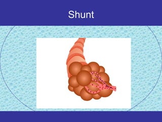 Shunt
 