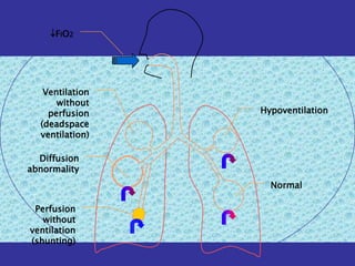 F I O2




   Ventilation
      without
    perfusion    Hypoventilation
  (deadspace
  ventilation)

  Diffusion
abnormality
                   Normal

 Perfusion
   without
ventilation
(shunting)
 