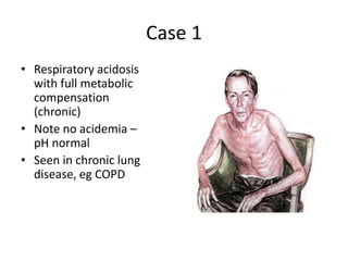 Case 1
• Respiratory acidosis
with full metabolic
compensation
(chronic)
• Note no acidemia –
pH normal
• Seen in chronic lung
disease, eg COPD
 