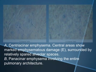 A, Centriacinar emphysema. Central areas show
marked emphysematous damage (E), surrounded by
relatively spared alveolar spaces.
B, Panacinar emphysema involving the entire
pulmonary architecture.
 
