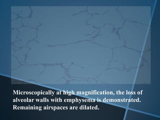 Microscopically at high magnification, the loss of
alveolar walls with emphysema is demonstrated.
Remaining airspaces are dilated.
 