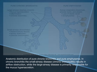 Anatomic distribution of pure chronic bronchitis and pure emphysema. In
chronic bronchitis the small-airway disease (chronic bronchiolitis) results in
airflow obstruction, while the large-airway disease is primarily responsible for
the mucus hypersecretion.
 