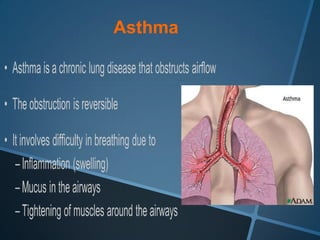 Asthma
 