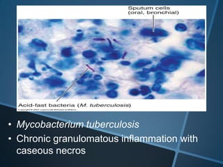 • Mycobacterium tuberculosis
• Chronic granulomatous inflammation with
  caseous necros
 