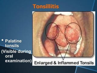 Tonsillitis




• Palatine
  tonsils
(Visible during
  oral
  examination)
 