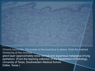Chronic bronchitis. The lumen of the bronchus is above. Note the marked
thickening of the mucous
gland layer (approximately twice normal) and squamous metaplasia of lung
epithelium. (From the teaching collection of the Department of Pathology,
University of Texas, Southwestern Medical School,
Dallas, Texas.)
 