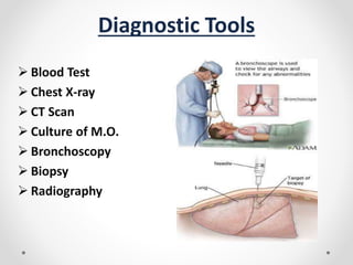 Diagnostic Tools
 Blood Test
 Chest X-ray
 CT Scan
 Culture of M.O.
 Bronchoscopy
 Biopsy
 Radiography
 
