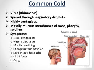 Common Cold
 Virus (Rhinovirus)
 Spread through respiratory droplets
 Highly contagious
 Initially mucous membranes of nose, pharynx
swollen
 Symptoms:
o Nasal congestion
o watery discharge
o Mouth breathing
o Change in tone of voice
o Sore throat, headache
o slight fever
o Cough
 