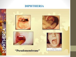 DIPHTHERIA
 