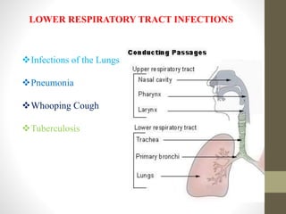 LOWER RESPIRATORY TRACT INFECTIONS
Infections of the Lungs
Pneumonia
Whooping Cough
Tuberculosis
 