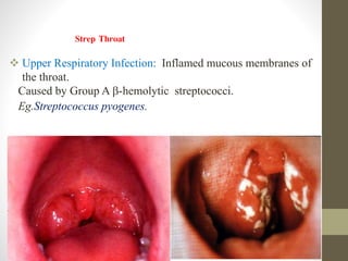  Upper Respiratory Infection: Inflamed mucous membranes of
the throat.
Strep Throat
Caused by Group A -hemolytic streptococci.
Eg.Streptococcus pyogenes.
 