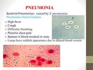 PNEUMONIA
Pneumonia-clinical features
o High fever
o Cough
o Difficulty breathing
o Pleuritic chest pain
o Sputum is blood streaked or rusty
o Lungs have reddish appearance due to dilated blood vessels
Bacterial Pneumoniae: caused by S. pneumoniae
 