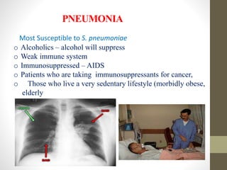 PNEUMONIA
o Alcoholics – alcohol will suppress
o Weak immune system
o Immunosuppressed – AIDS
o Patients who are taking immunosuppressants for cancer,
o Those who live a very sedentary lifestyle (morbidly obese,
elderly
Most Susceptible to S. pneumoniae
 