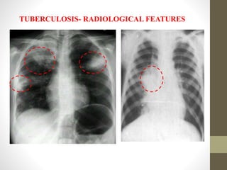 TUBERCULOSIS- RADIOLOGICAL FEATURES
 