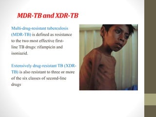 MDR-TBand XDR-TB
Multi-drug-resistant tuberculosis
(MDR-TB) is defined as resistance
to the two most effective first-
line TB drugs: rifampicin and
isoniazid.
Extensively drug-resistant TB (XDR-
TB) is also resistant to three or more
of the six classes of second-line
drugs
 