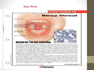 Strep Throat
 